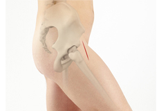 Outpatient Anterior Approach Hip Replacement