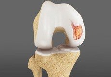 Chondral or Articular Cartilage Defects