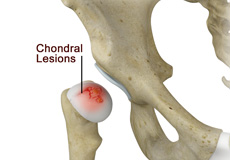 Chondral Lesions or Injuries