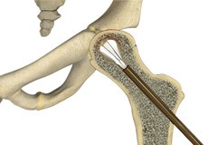 Core Decompression for Avascular Necrosis of the Hip