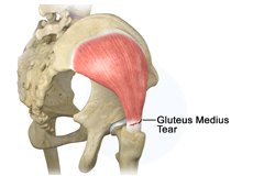 Gluteus Medius Tear