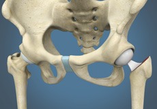 Hip Hemiarthroplasty