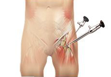 Hip Arthroscopy