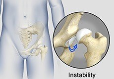 Hip Instability