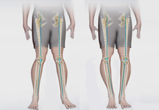 Knee Angular Deformities