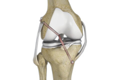 Multiligament Knee Injuries