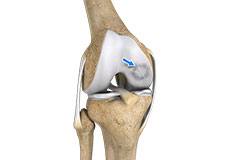 Osteochondritis Dissecans of the Knee