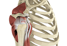 Rotator Cuff Tear