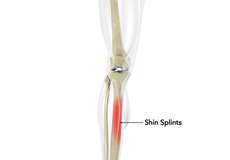 Shin Splints