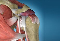 Shoulder Impingement