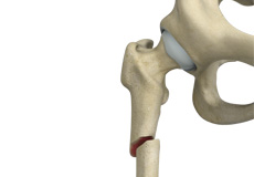 Subtrochanteric Hip Fracture