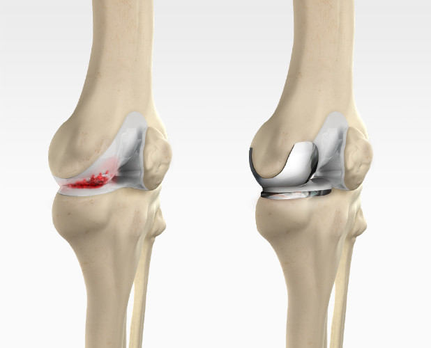 Unicompartmental/Partial Knee Replacement